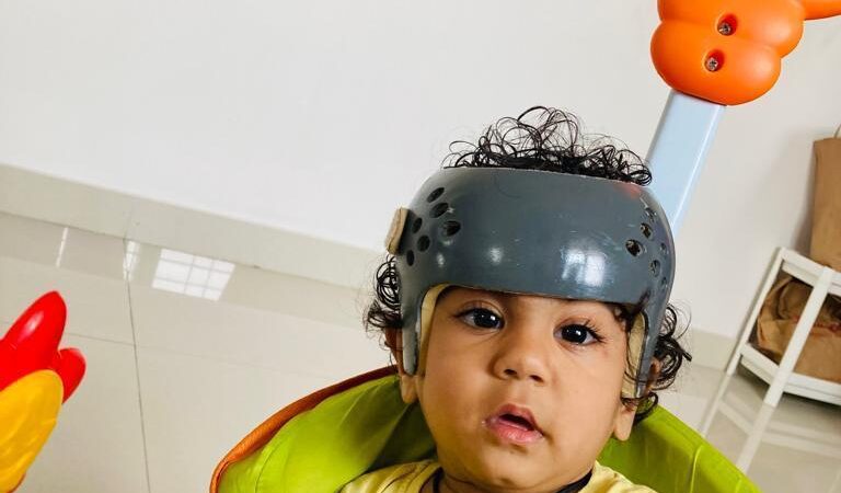 Rare Surgery for a Baby with Fused Skull